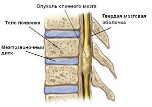 Tumorile măduvei spinării, tratamentul cancerului și prevenirea