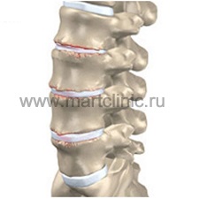 Osteocondroza - simptome, tratamentul osteocondrozei