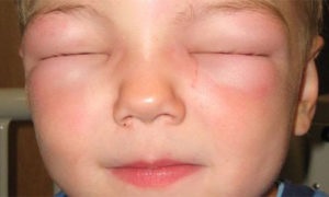 Angioedema gyermekek tünetei és kezelése