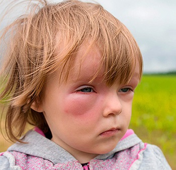 Quincke edem la copii Simptome, cauze, primul ajutor și tratamentul angioedemului la copil