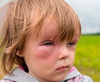 Quincke edem la copii Simptome, cauze, primul ajutor și tratamentul angioedemului la copil