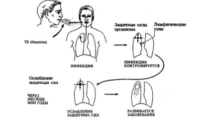 Forma deschisă de tuberculoză, deoarece este posibil să fie prinsă în contact cu persoana bolnavă