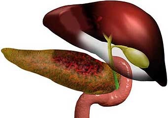 Pancreatita - o descriere a bolii