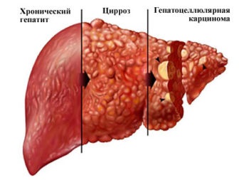 Curățarea ficatului hepatic, compoziția ceaiului din plante