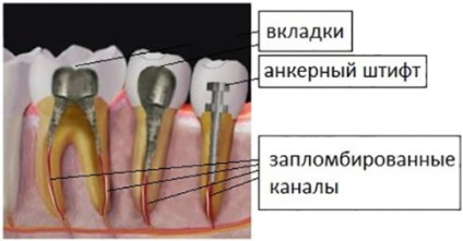 Rearanjarea canalelor de canal, probleme de repetare endodontică