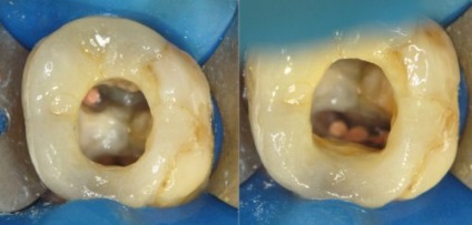 Rearanjarea canalelor de canal, probleme de repetare endodontică