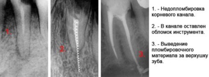 Rearanjarea canalelor de canal, probleme de repetare endodontică