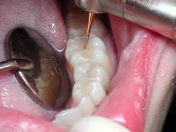 Umplerea dinților - tipuri de umpluturi dentare - simpladent dentar