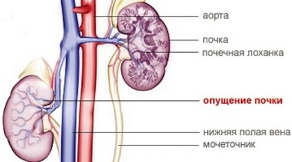 Sindopia tulpină renală și compoziția organelor polului superior