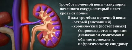 Sindopia tulpină renală și compoziția organelor polului superior