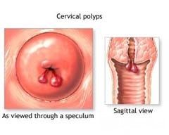Polipii cervicali - tratament, cauze, simptome