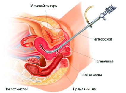 Polipii în simptomele uterului și tratamentul fără intervenție chirurgicală