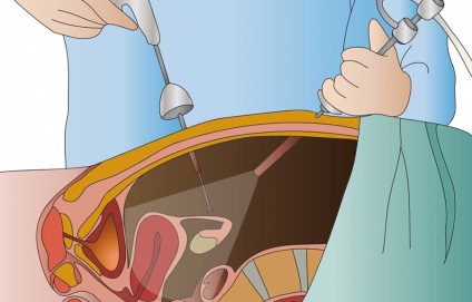 Polipii în simptomele uterului și tratamentul fără intervenție chirurgicală