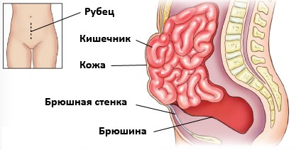 Hernia postoperatorie simptome și semne, manifestări