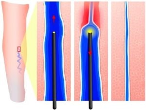Cauzele apariției asteriscelor vasculare pe picioare