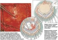 Craniotomie (tratament - chirurgie)