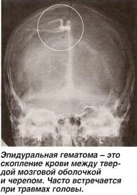 Craniotomie (tratament - chirurgie)