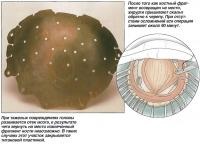 Craniotomie (tratament - chirurgie)