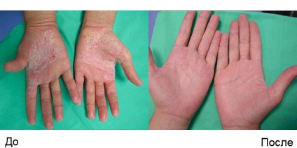 Psoriazisul și alte boli cronice ale pielii