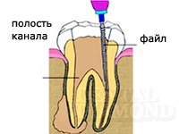 Nyitásakor a fogat csatorna, módszerek eltávolítása lapok csapok