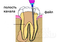 Dentare rădăcină canal radiere, metode de eliminare a filelor, bolțuri