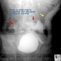 Ruptura vezicii urinare, urologul meu