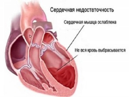 Insuficiență cardiacă