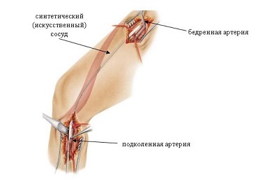 Măsurarea vaselor membrelor inferioare este ceea ce este, indicațiile, complicațiile și recuperarea