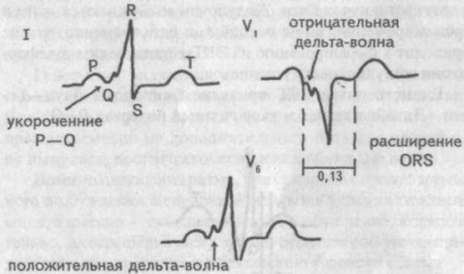 Wolff-Parkinson-White (WPW), tipul în acest sindrom este impulsul sinusului, trecând pe dreapta