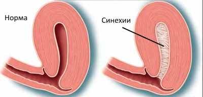 Synechia în cavitatea uterină ceea ce este, tratamentul și simptomele