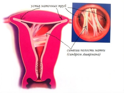 Synechia în cavitatea uterină ceea ce este, tratamentul și simptomele