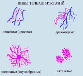 Asteriscuri vasculare pe picioare, tratament, îndepărtarea telangiectaziei și a cauzelor