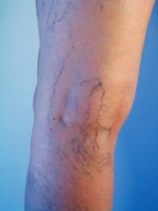Asteriscuri vasculare pe picioare, tratament, îndepărtarea telangiectaziei și a cauzelor