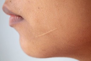 Metode pentru eliminarea cicatricilor și cicatricilor pe corp