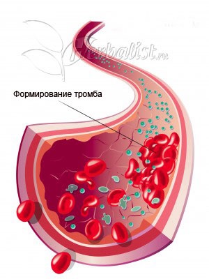 Tromboflebita - tratamentul tromboflebitei