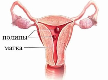 Премахване на полипи в техниките на матката и индикативни цени