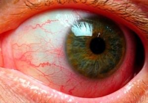 Uveitis okoz szem, típusai, tünetei, diagnózis és kezelés