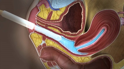 Uzi uteri și anexe (uzi mic pelvis) in - medlab - spb