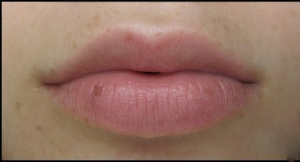 Frecvențele pe buze provoacă pigmentare și împiedică apariția acestora