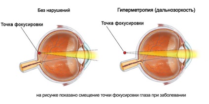 Életkor távollátás, távollátás kezelése és korrekciója