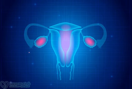 Întregul adevăr despre miomul uterului