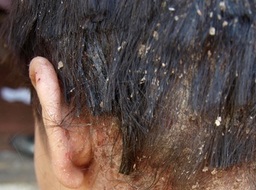 5 Cele mai frecvente cauze de mâncărime ale capului și căderea părului, se acumulează pe piele