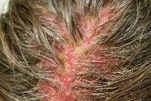 5 Cele mai frecvente cauze de mâncărime ale capului și căderea părului, se acumulează pe piele
