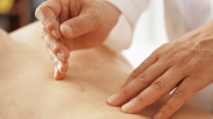 Acupunctura - acupunctura, metode netraditionale de tratament, chasen
