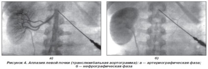 Aplasia din codul rinichiului drept și stâng de micro, cauze, simptome, handicap