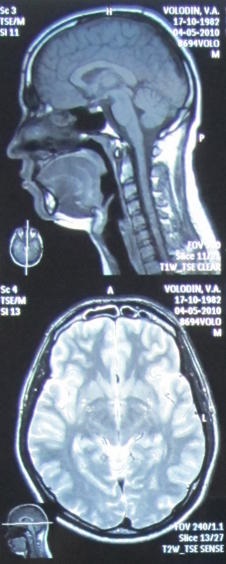 Chistul arachnoidic - cauze, simptome, diagnostic, tratament și consecințe