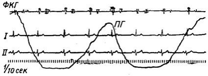 Aritmii cauzate de o încălcare a funcției cardiace automate