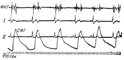 Aritmii cauzate de o încălcare a funcției cardiace automate