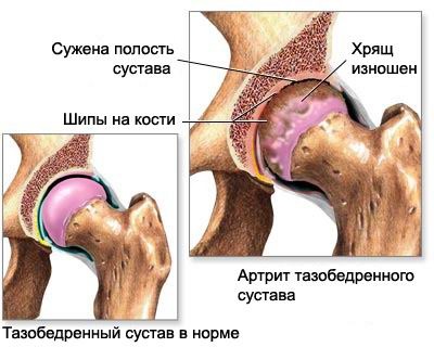 Artrita articulațiilor - tratament în centrul medical 