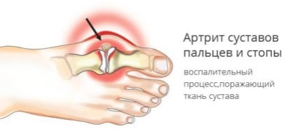 Durere la nivelul piciorului de lângă degete, cauze comune ale simptomelor